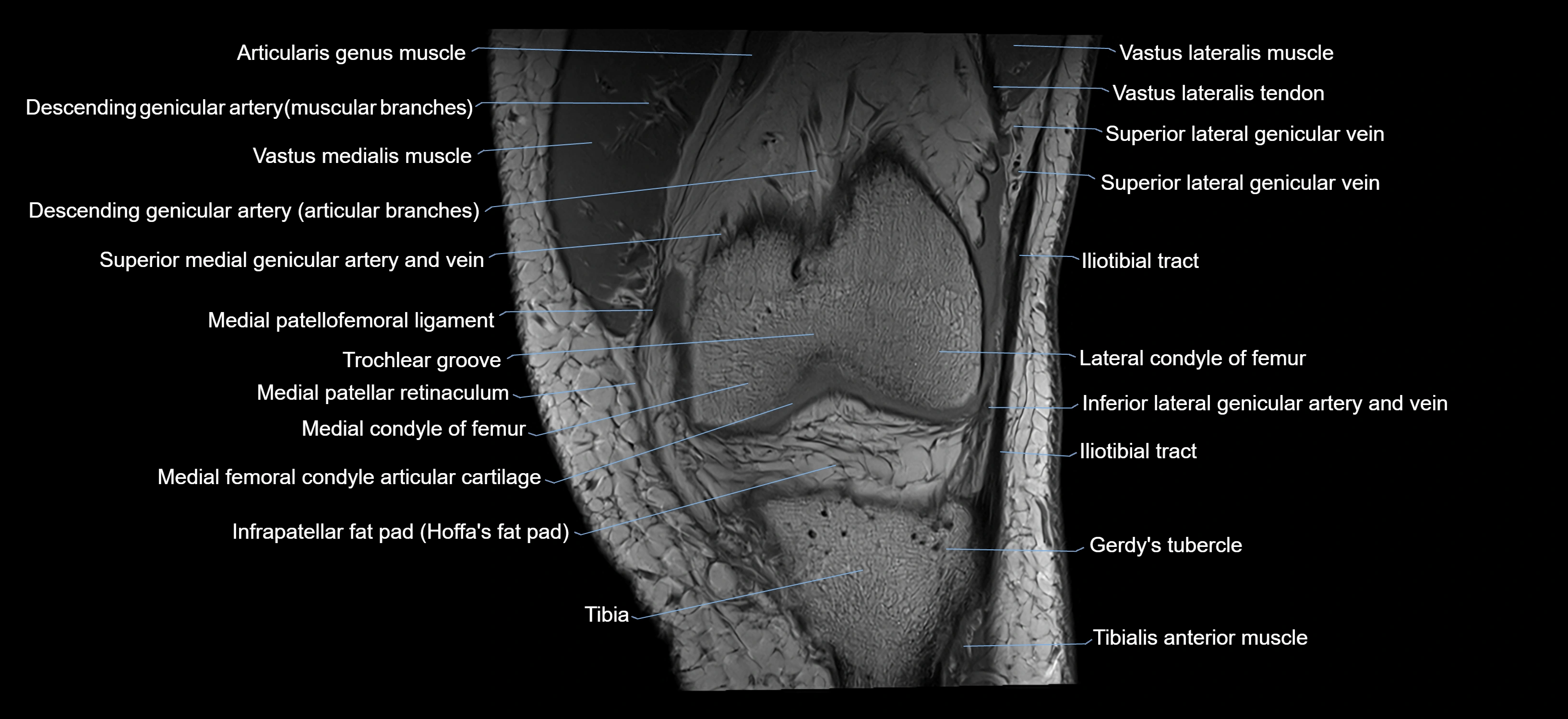 MRI knee coronal cross sectional anatomy labelled 3T radiology  image-04001-00012.webp